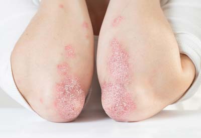 psoriasis codos